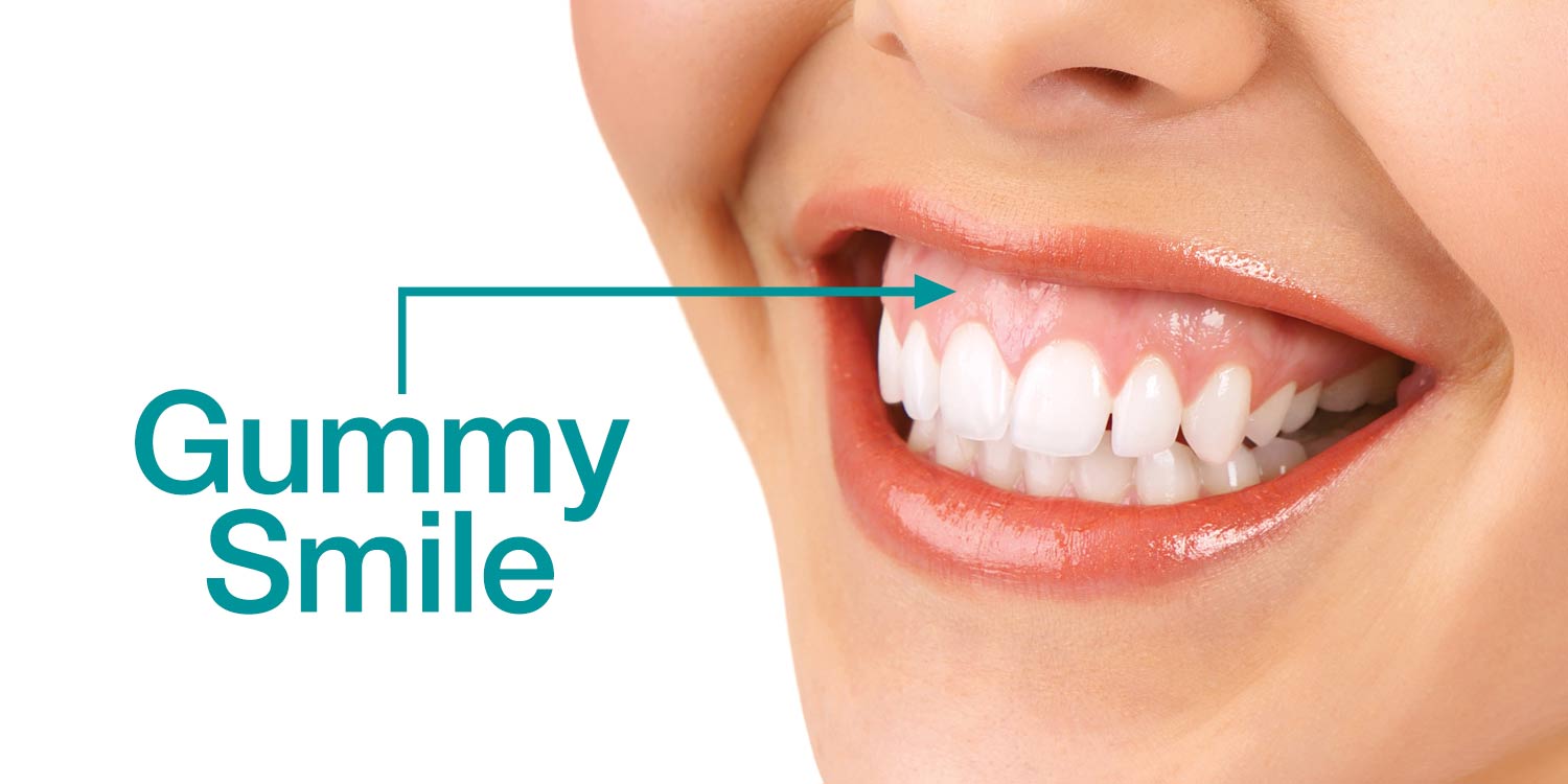 Do You Have a “Gummy Smile?” | Knoxville Dentist Dr. Jack Haney