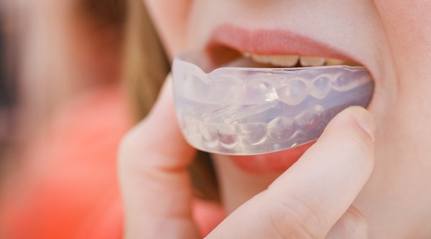Knoxville Dental Mouth Guards